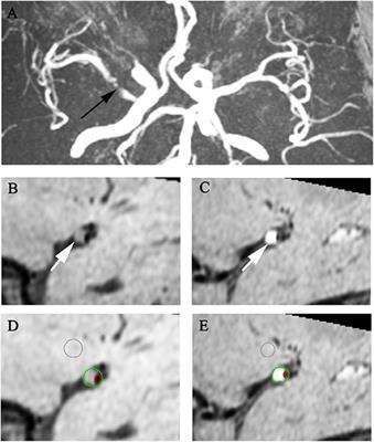 Regression of Plaque Enhancement Within Symptomatic Middle Cerebral Artery Atherosclerosis: A High-Resolution MRI Study